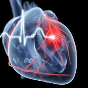 Heart attack, artwork