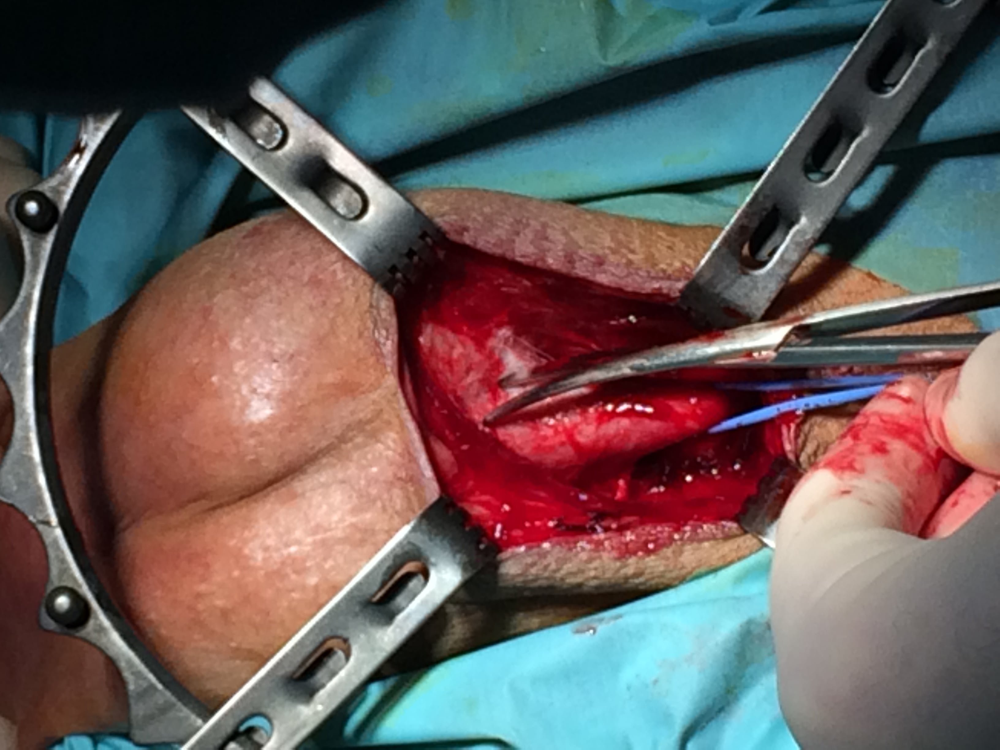 interventie chirurgicala