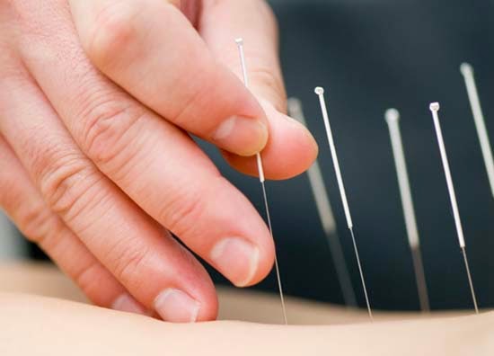 Acupunctura