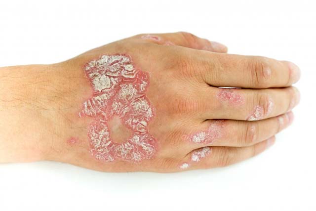 Psoriazisul și dieta