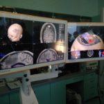 intervenții neurochirurgicale asistate SCJU Cluj Napoca 2