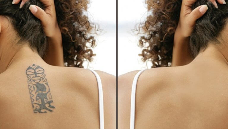 Ștergere tatuaje - informații complete despre îndepărtarea cu laser a tatuajelor
